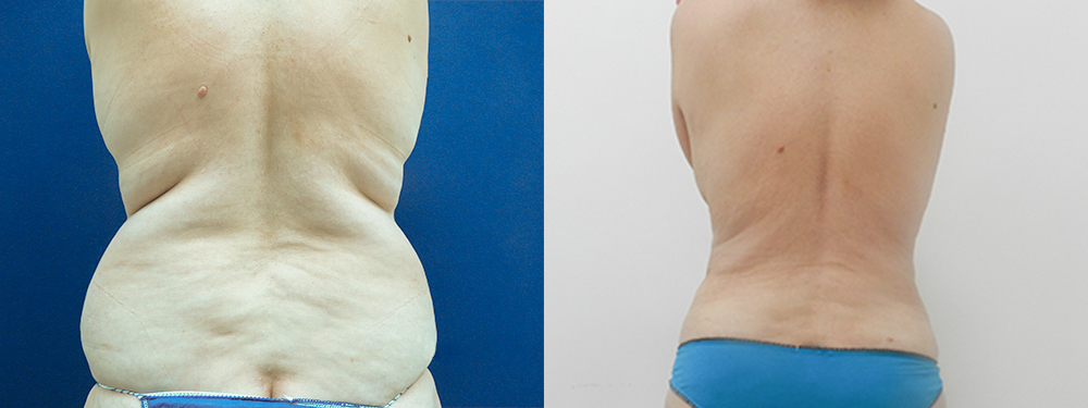 Liposuction Before and after Photos by Dr. Algird Mameniskis | Avana