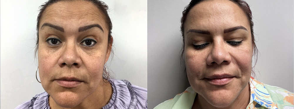 Botox Before and After