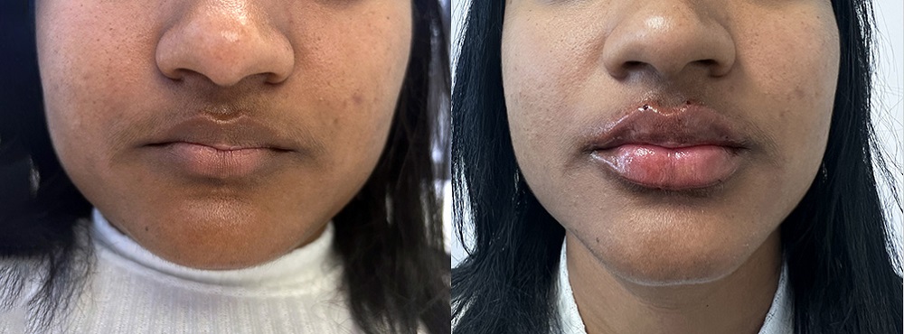 Lip Fillers Before and After