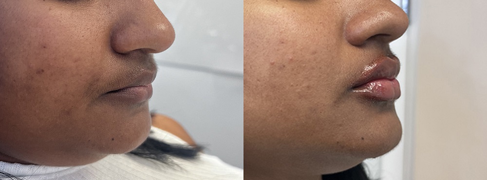 Lip Fillers Before and After