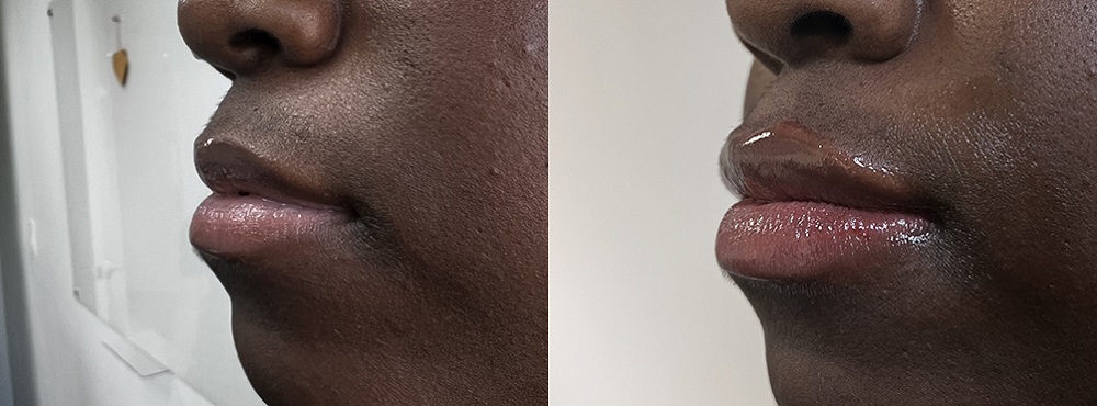 Lip Fillers Before and After