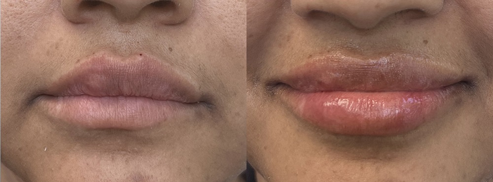 Lip Fillers Before and After