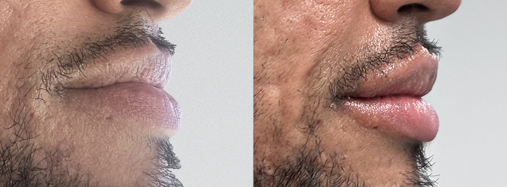 Lip Fillers Before and After