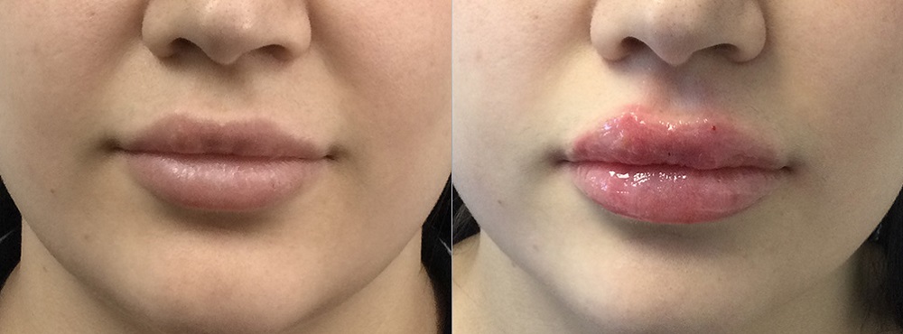 Lip Fillers Before and After