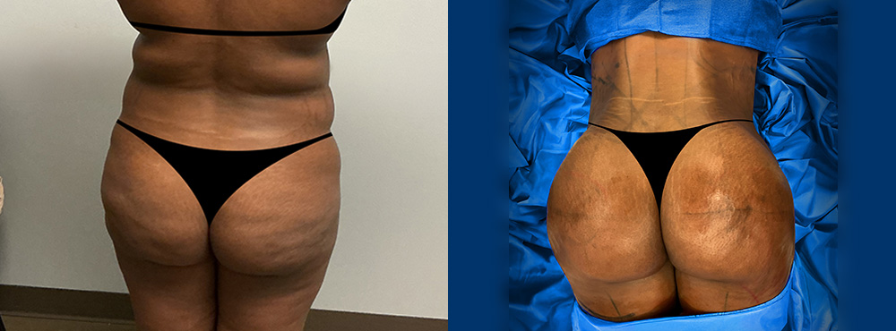 Butt Lift Before and After