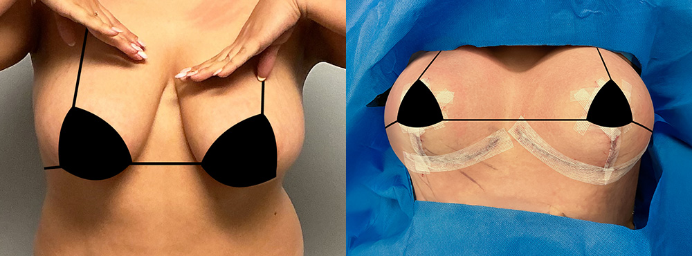 Breast Lift Before and After