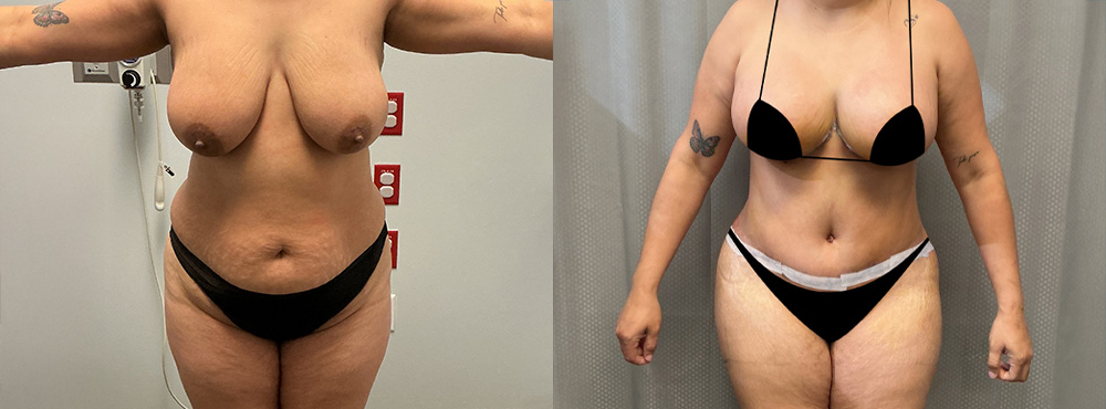 Mommy Makeover Before and After