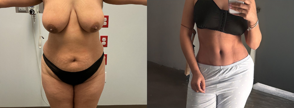Mommy Makeover Before and After
