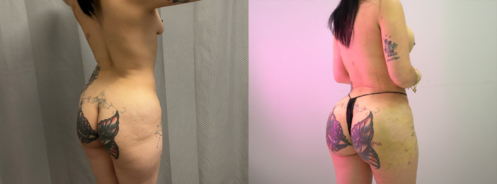 BBL Before and After in Dallas