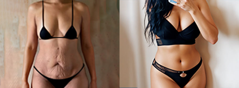 Mommy Makeover Before and After