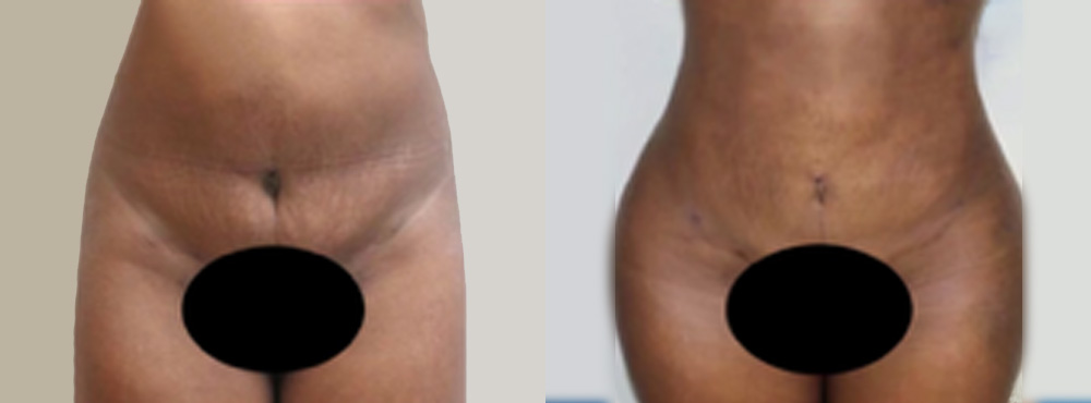 Liposuction Before and After in Dallas