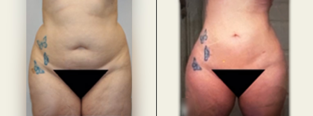 Liposuction Before and After in Dallas
