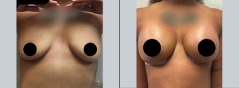 Breast Augmentation Before and After