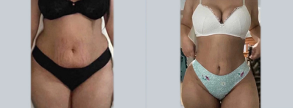 Lipo 360 Before and After