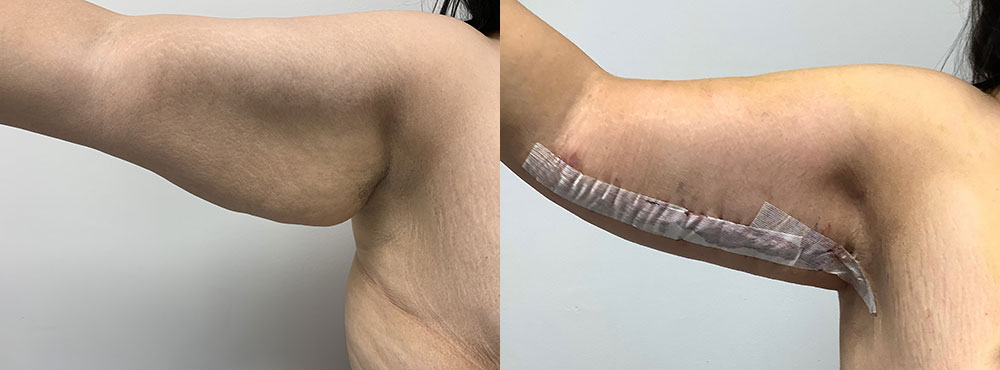 brachioplasty before and after