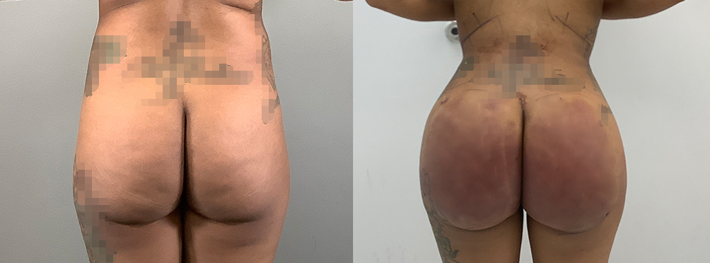 Brazilian Butt Lift Before and After