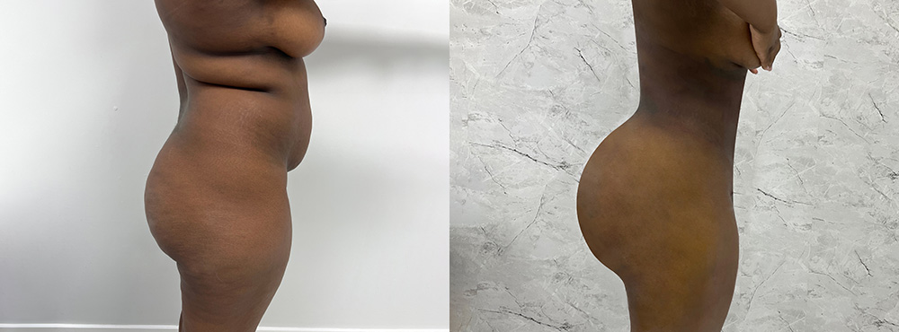 BBL Before and After