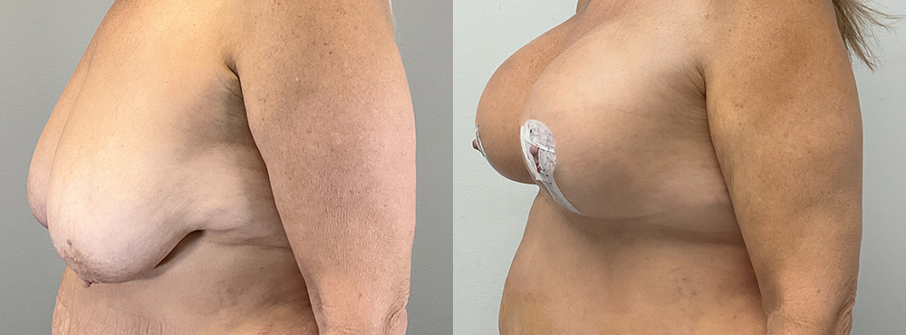 Breast Lift Before and After