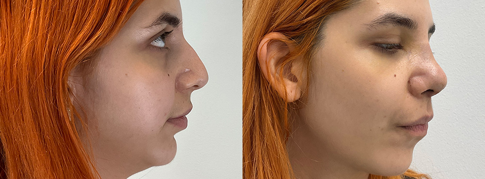 Rhinoplasty Before and After