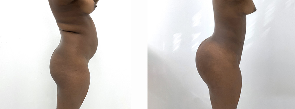 BBL Before and After