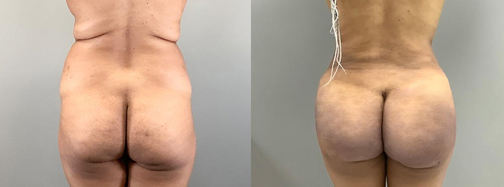 Brazilian Butt Lift Before and After