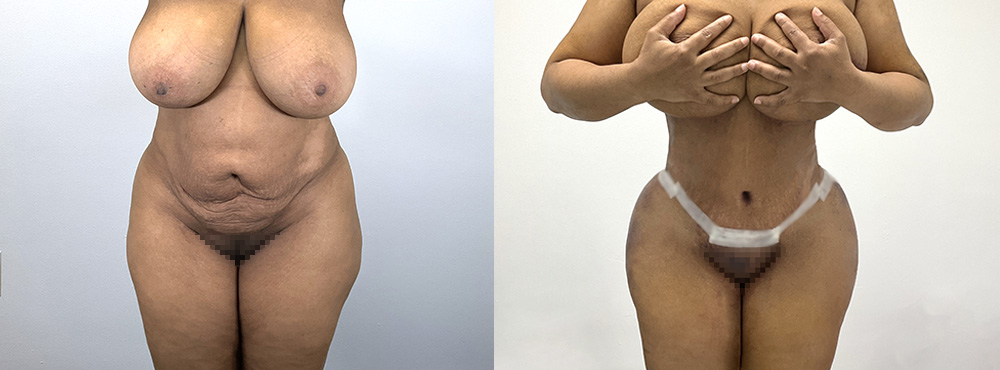 BBL Before and After