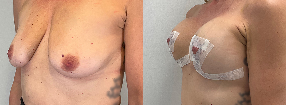 Breast Lift Before and After