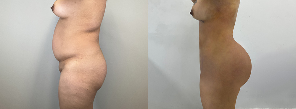 BBL Before and After