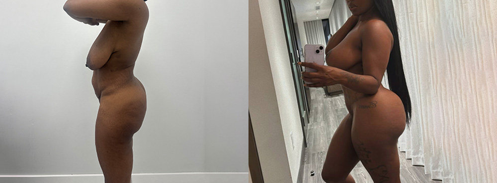 Mommy Makeover Before and After