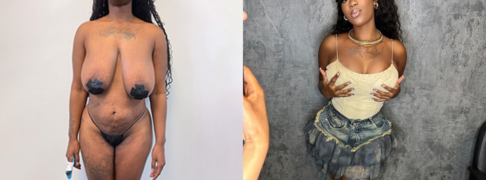 Mommy Makeover Before and After