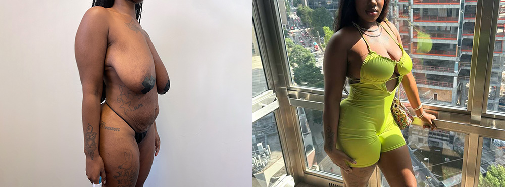 Mommy Makeover Before and After