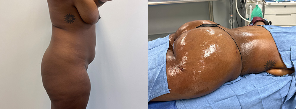 Brazilian Butt Lift before and after