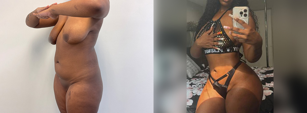 Brazilian Butt Lift before and after