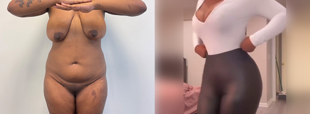 Brazilian Butt Lift before and after