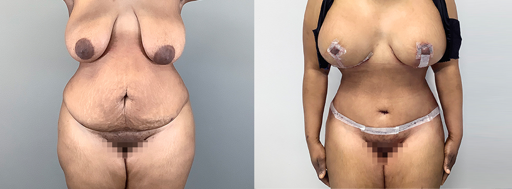 Mommy Makeover Before and After