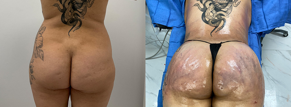 Brazilian Butt Lift Before and After