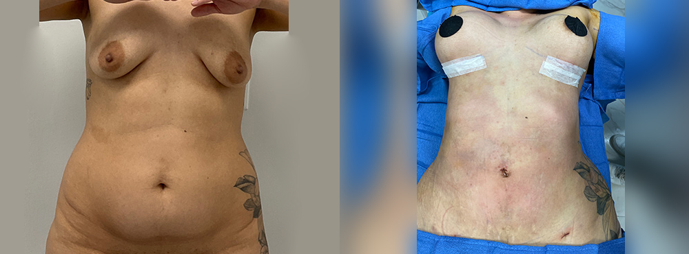 Brazilian Butt Lift Before and After