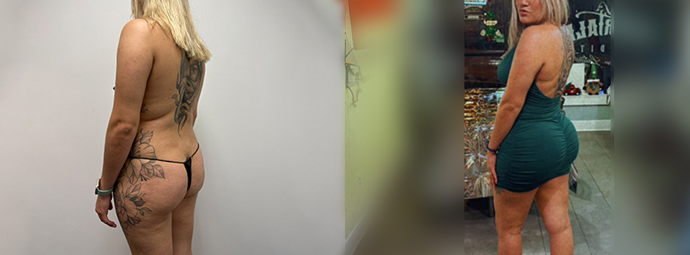 Brazilian Butt Lift Before and After