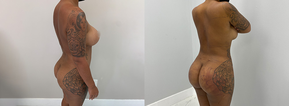 Brazilian Butt Lift Before and After