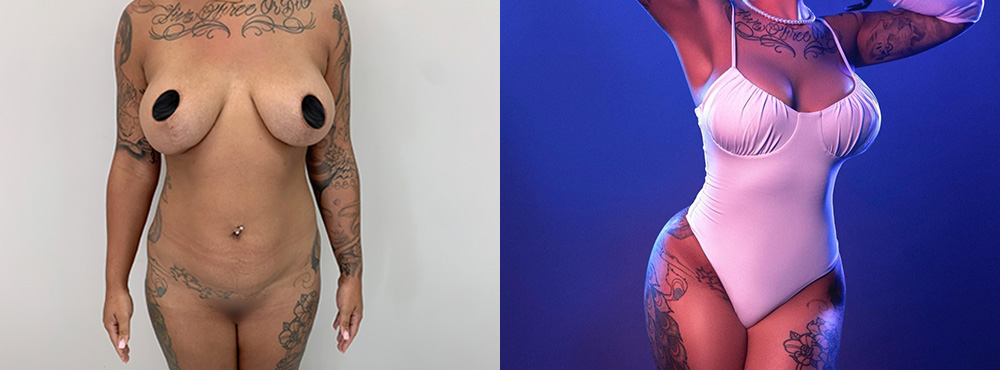 Brazilian Butt Lift Before and After