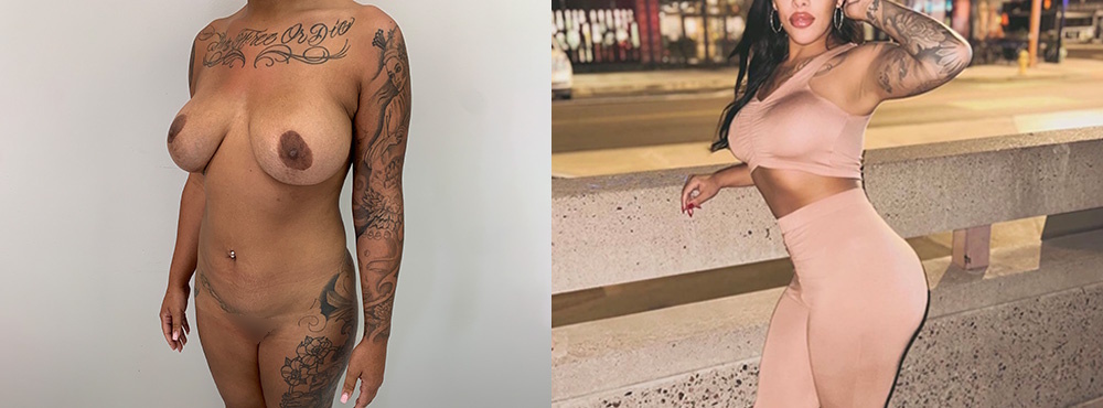 Brazilian Butt Lift Before and After