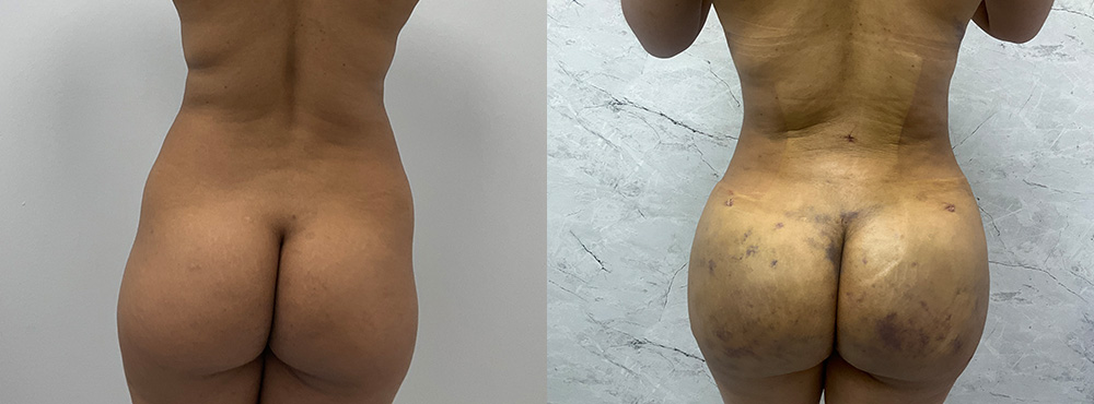 Mommy Makeover Before and After