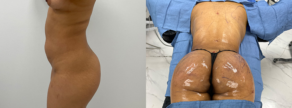 Mommy Makeover Before and After