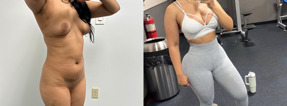 Mommy Makeover Before and After