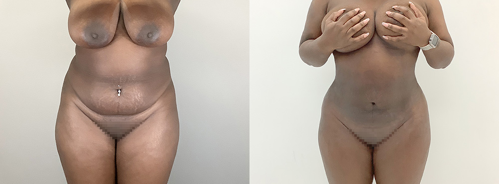 Lipo Before and After