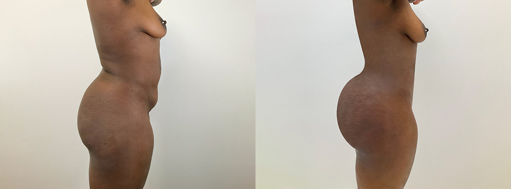 BBL Before and After