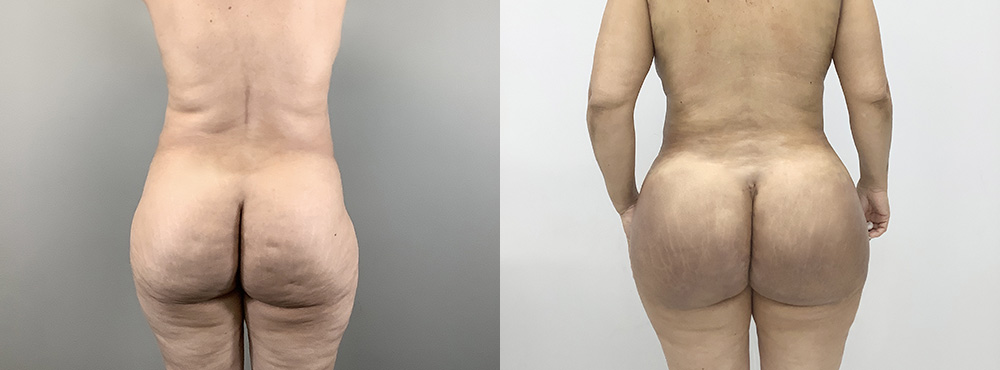 BBL Before and After