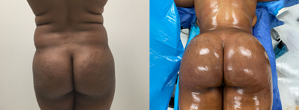Brazilian Butt Lift Before and After