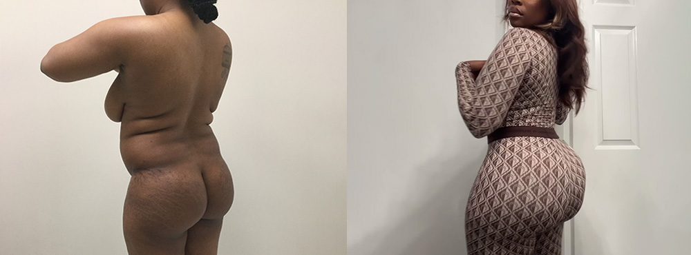 Brazilian Butt Lift Before and After