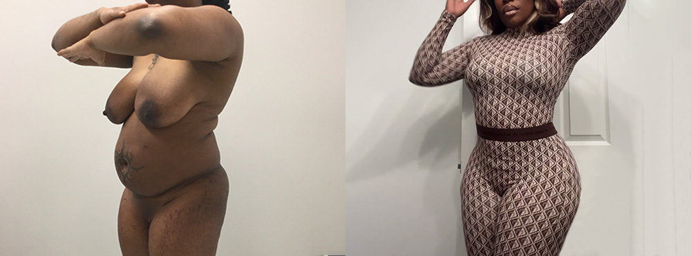 Brazilian Butt Lift Before and After